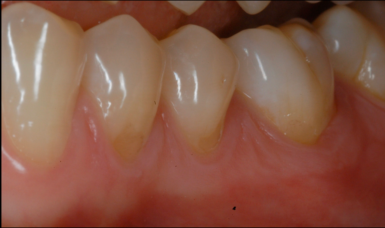 Losing the sides of your teeth !