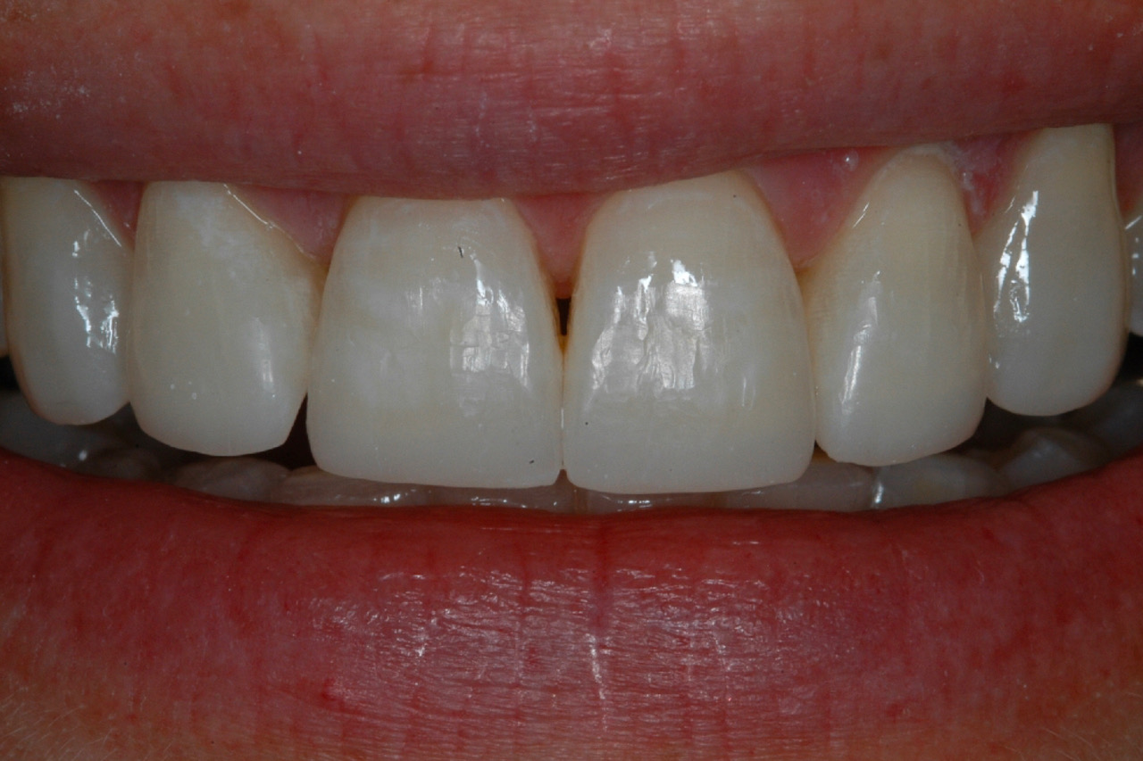 After Composite Buildups