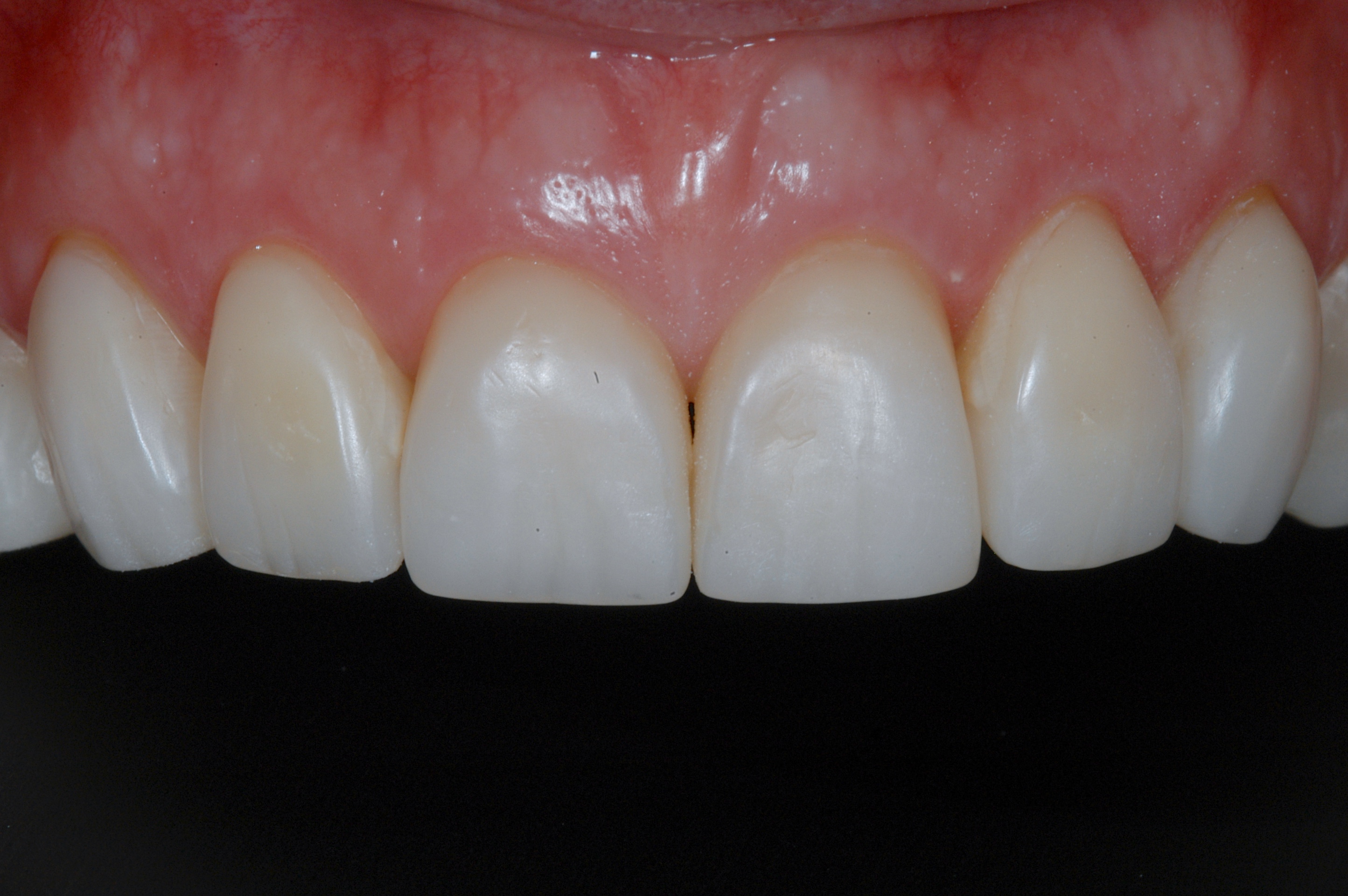 Conservative treatment of erosion