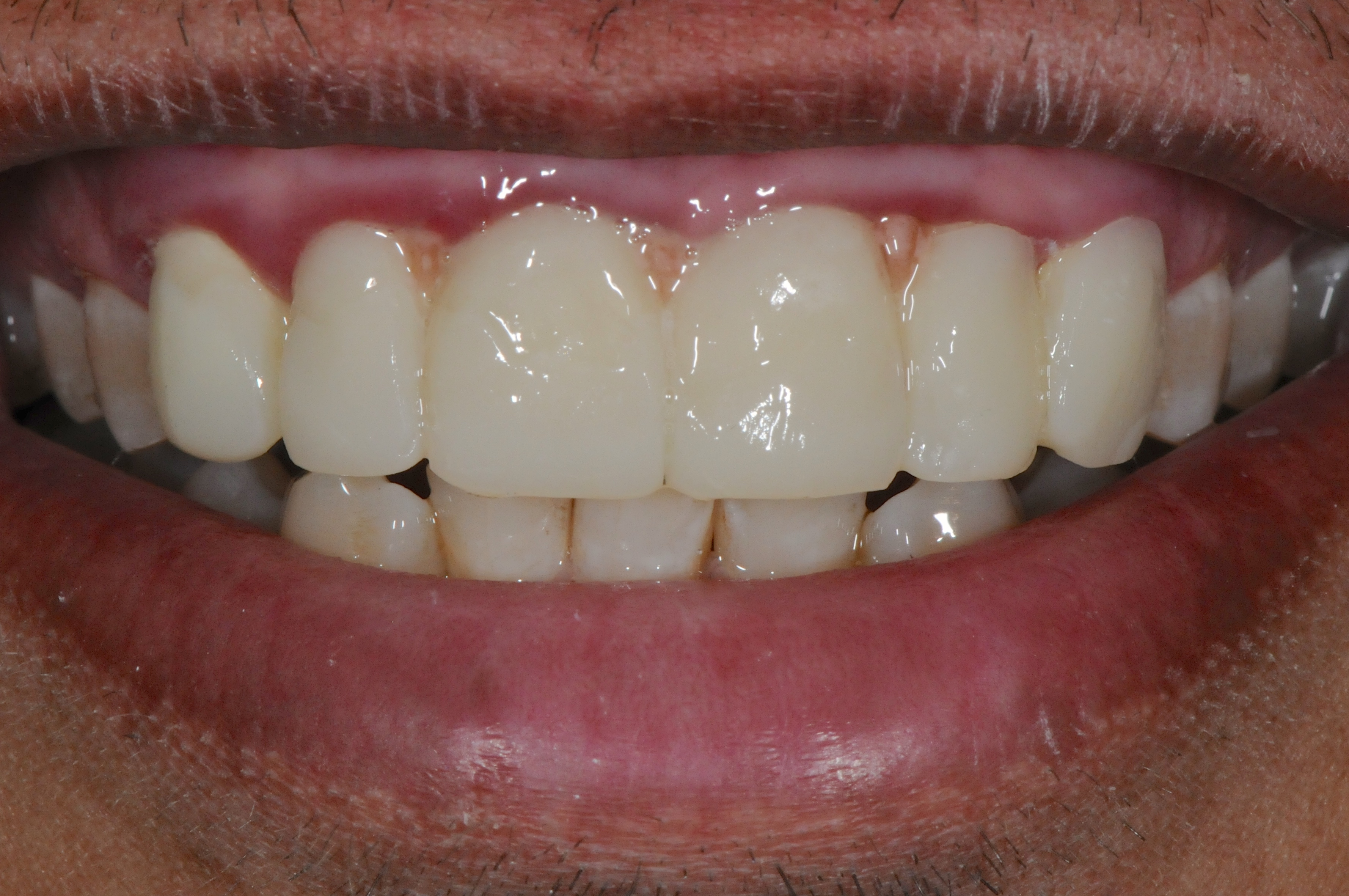 Services Correcting Dentistry Performed Overseas Brisbane Prosthodontics