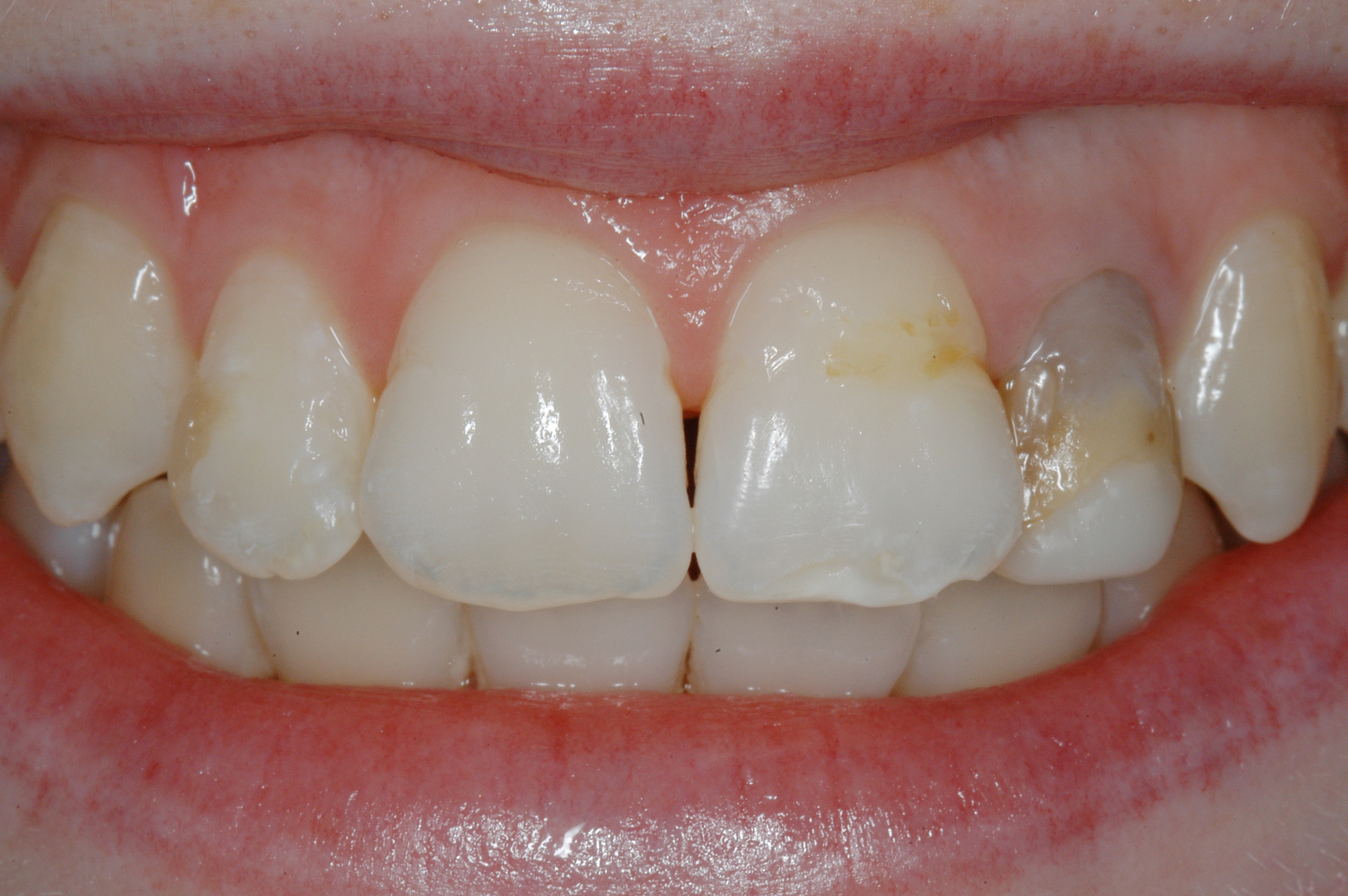 Services Single Tooth Whitening Brisbane Prosthodontics