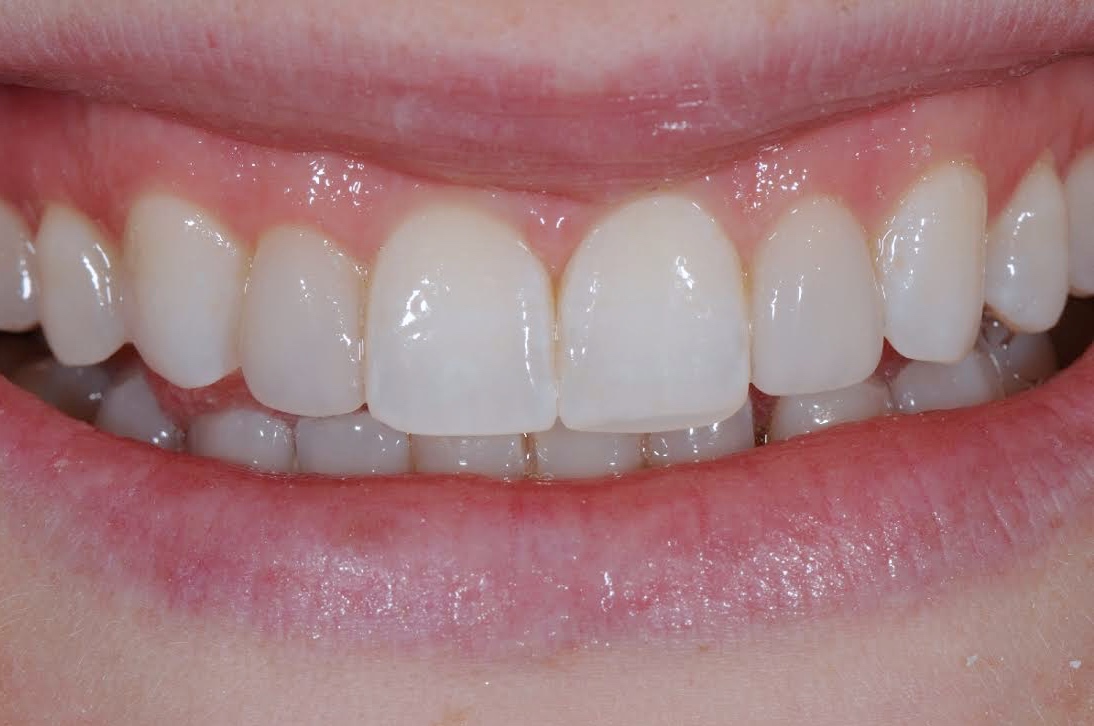 Services Peg Laterals Brisbane Prosthodontics