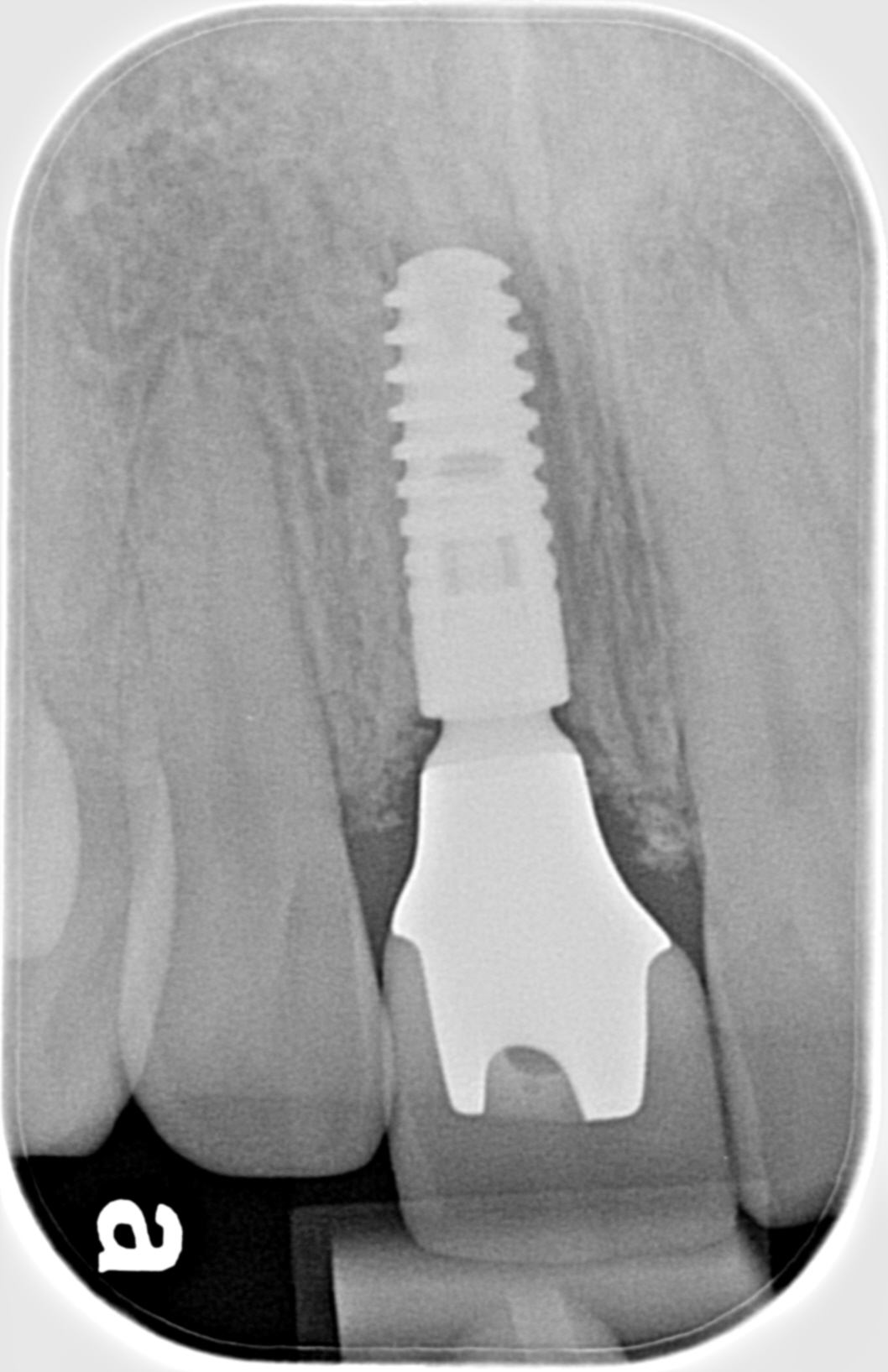 Implant Abutment Not Seated at Melissa Avila blog