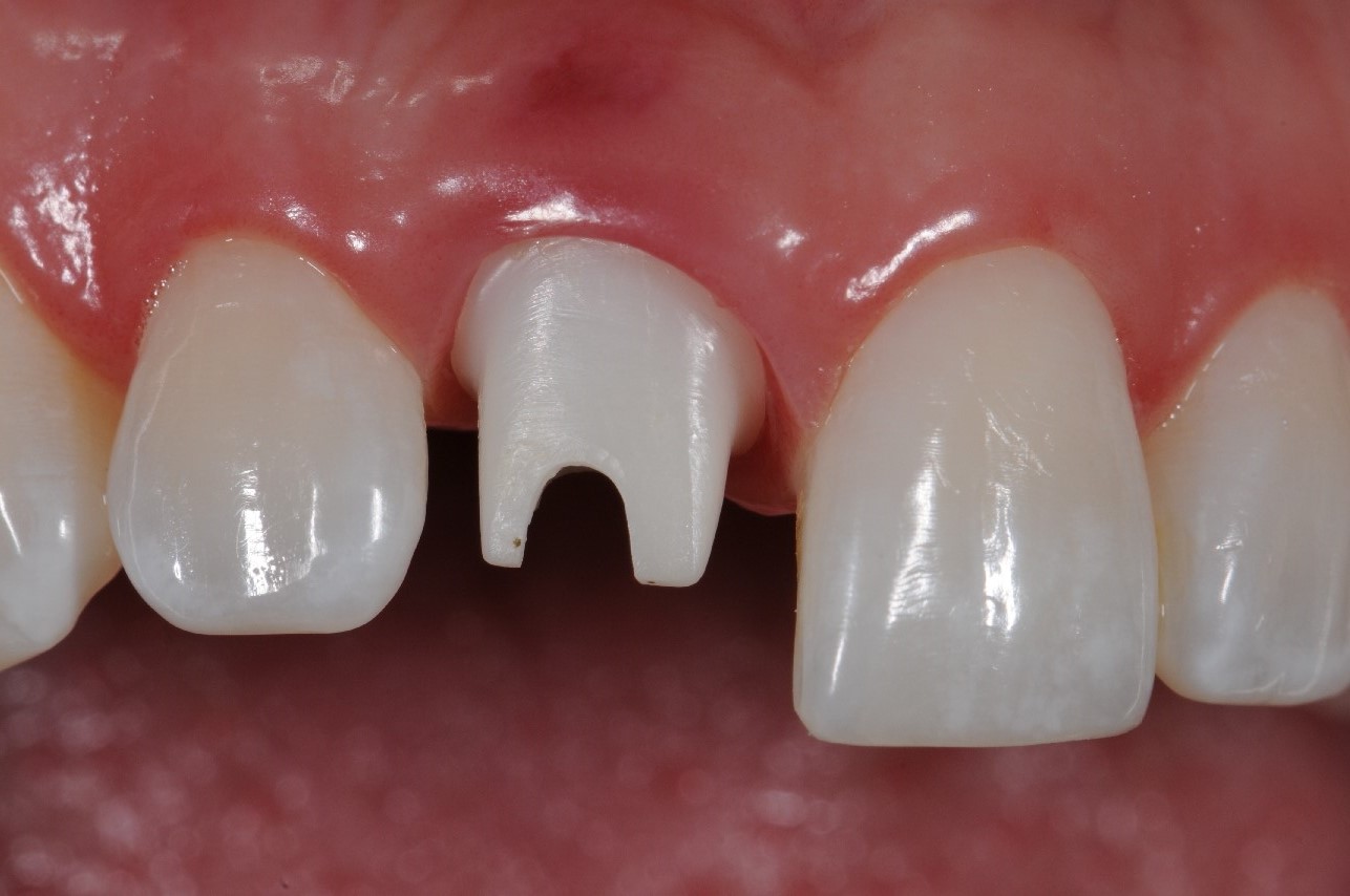 The implant abutment in place