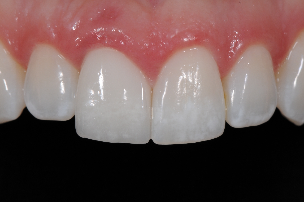 The final crown on the implant