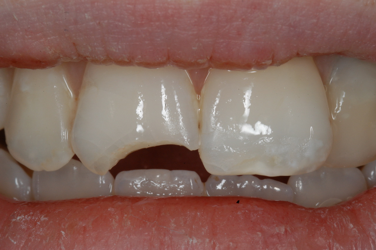 Services Nice Composite Restorations Brisbane Prosthodontics