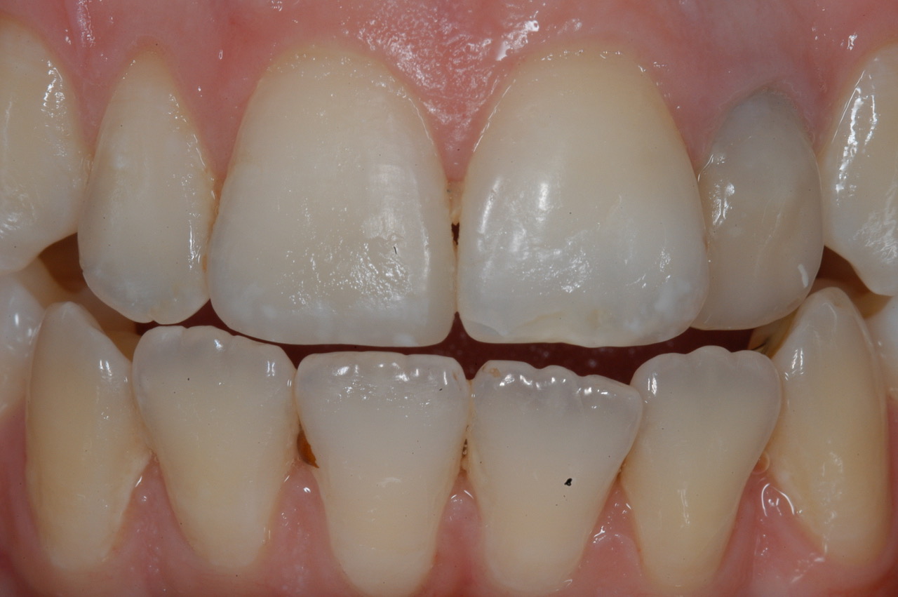 Services Nice Composite Restorations Brisbane Prosthodontics