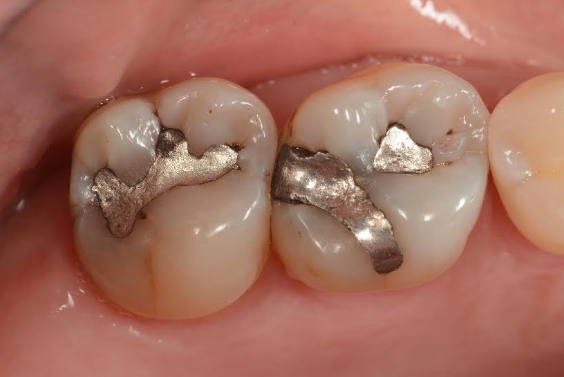 Old Amalgams in place