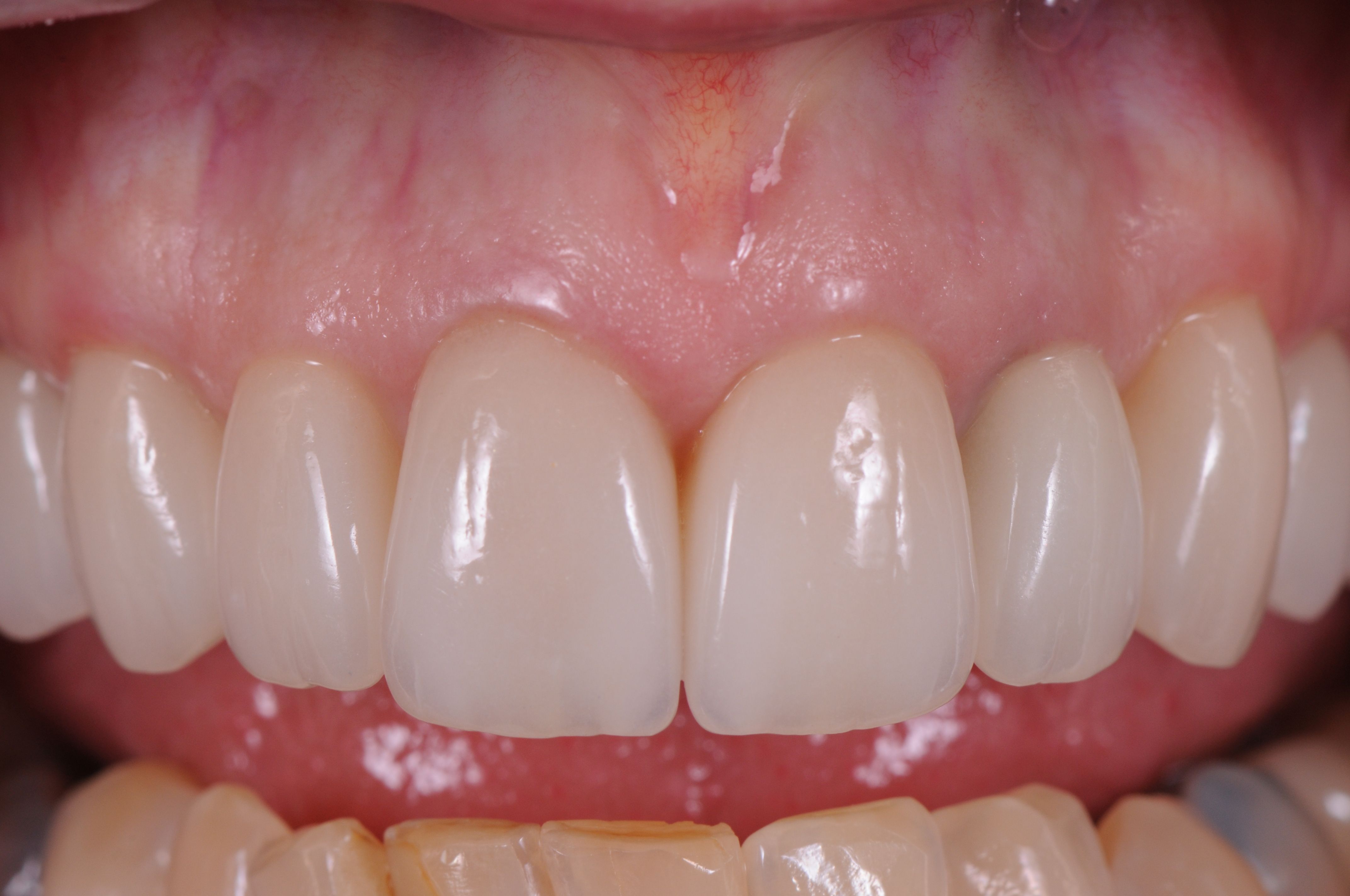 Perfectly made and fitted porcelain allows perfect gum health