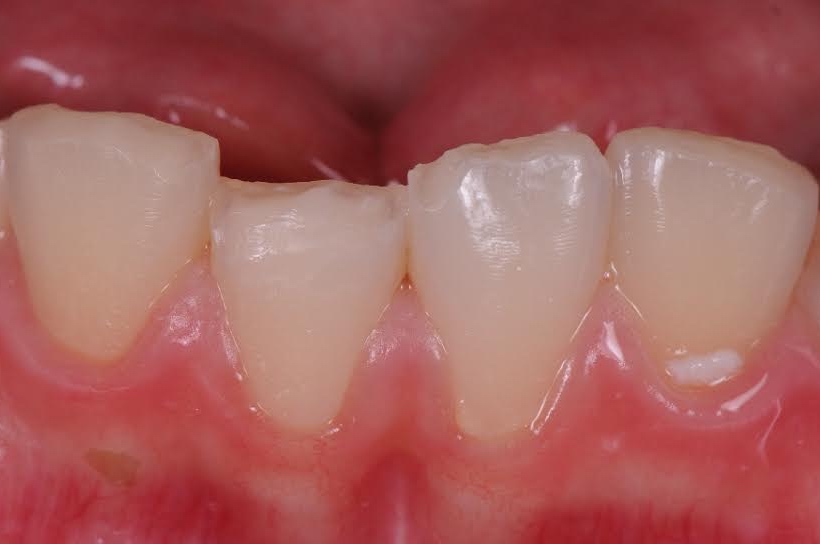 Services Trauma and Chipped Teeth Brisbane Prosthodontics