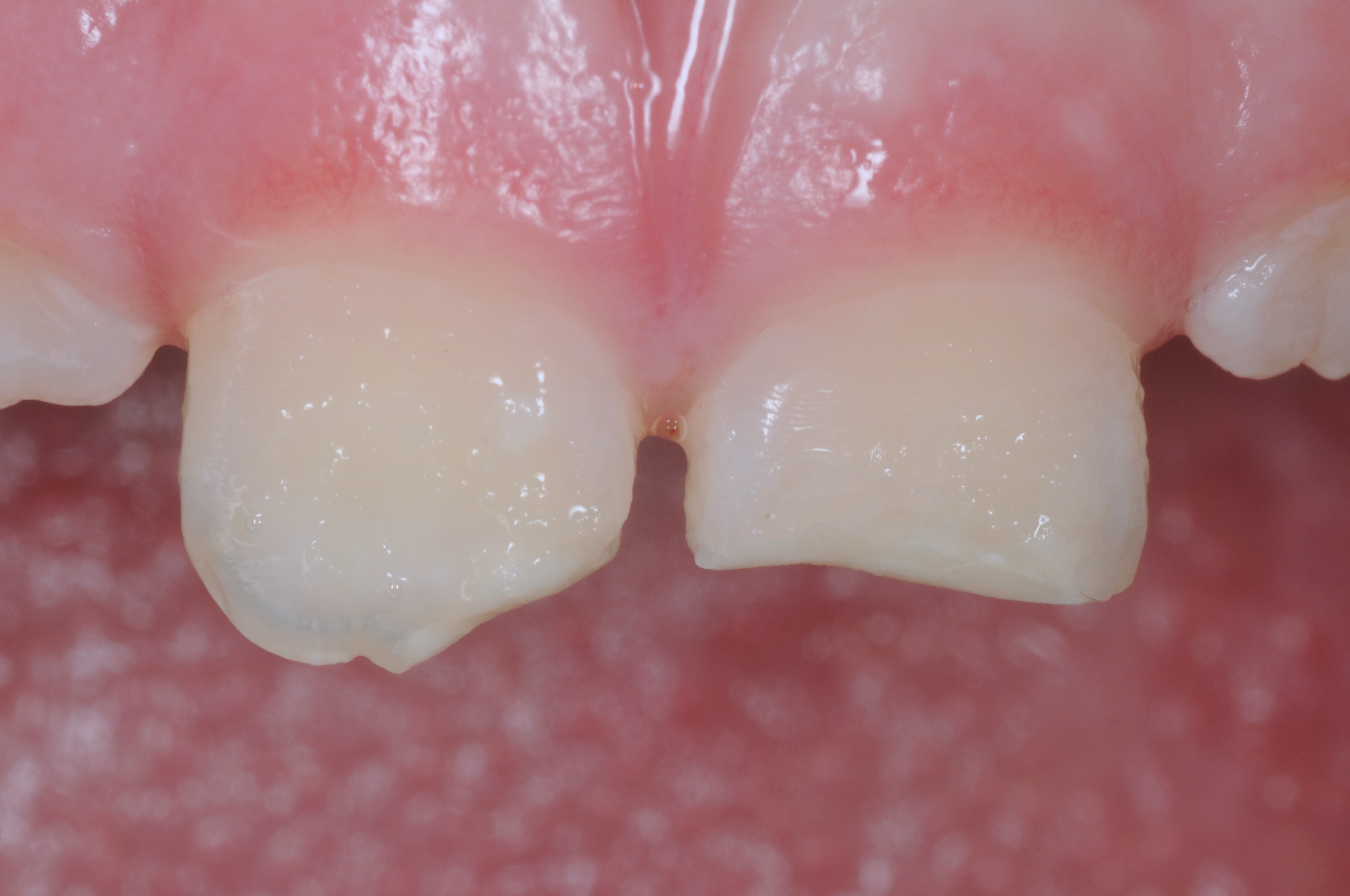 Services Trauma and Chipped Teeth Brisbane Prosthodontics