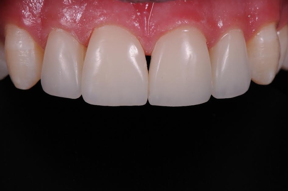 Services Composite Buildups Brisbane Prosthodontics