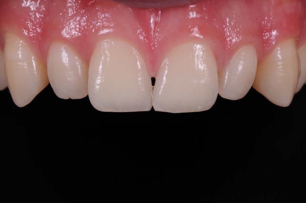 Services Composite Buildups Brisbane Prosthodontics