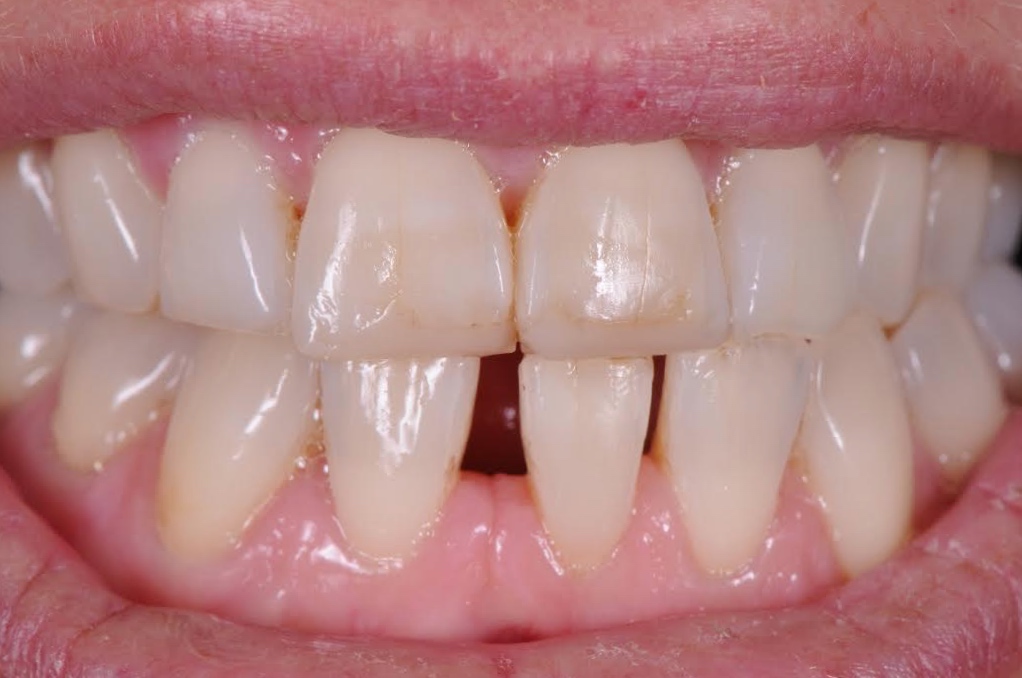 Services Composite Buildups Brisbane Prosthodontics