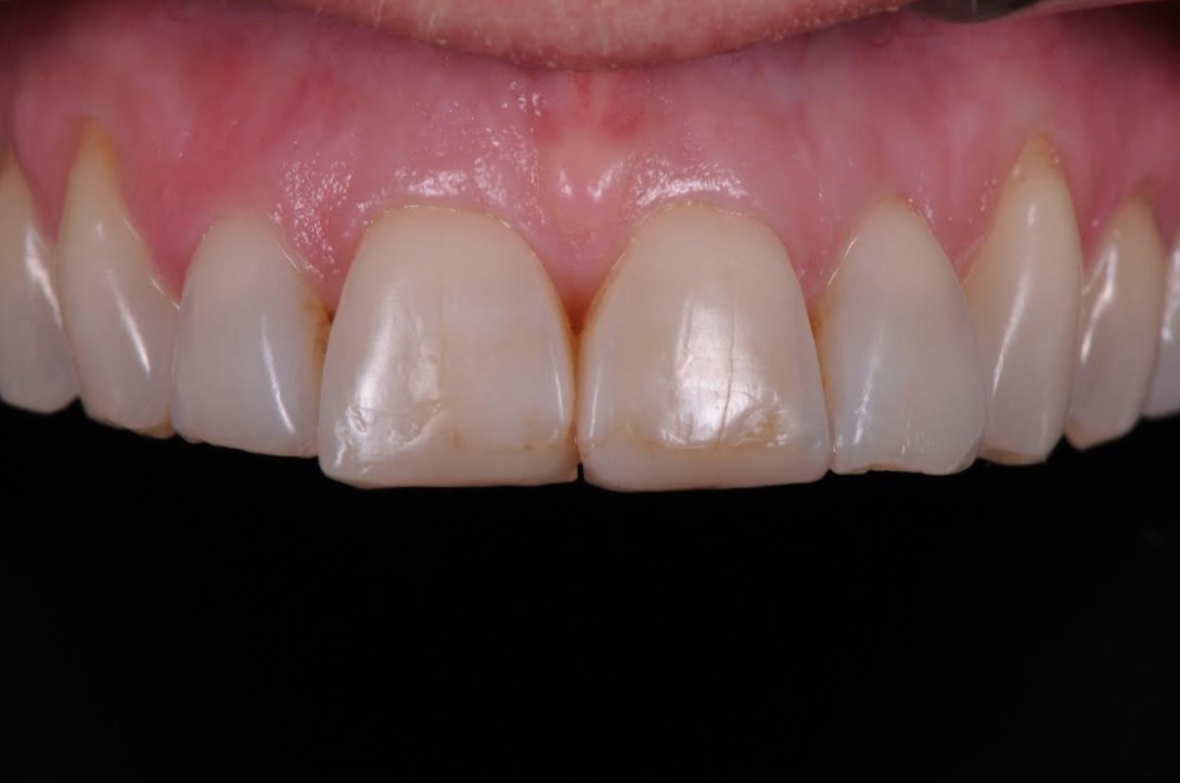 Services Composite Buildups Brisbane Prosthodontics