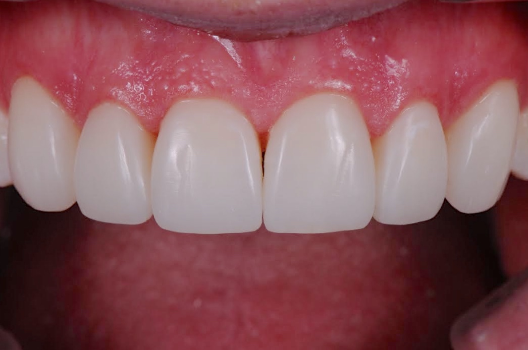 Services Composite Veneers Brisbane Prosthodontics