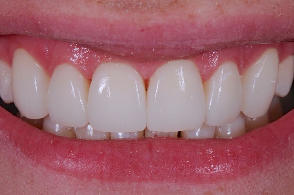 Services Composite Veneers Brisbane Prosthodontics