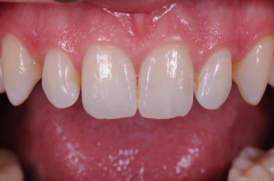 Services Composite Veneers Brisbane Prosthodontics