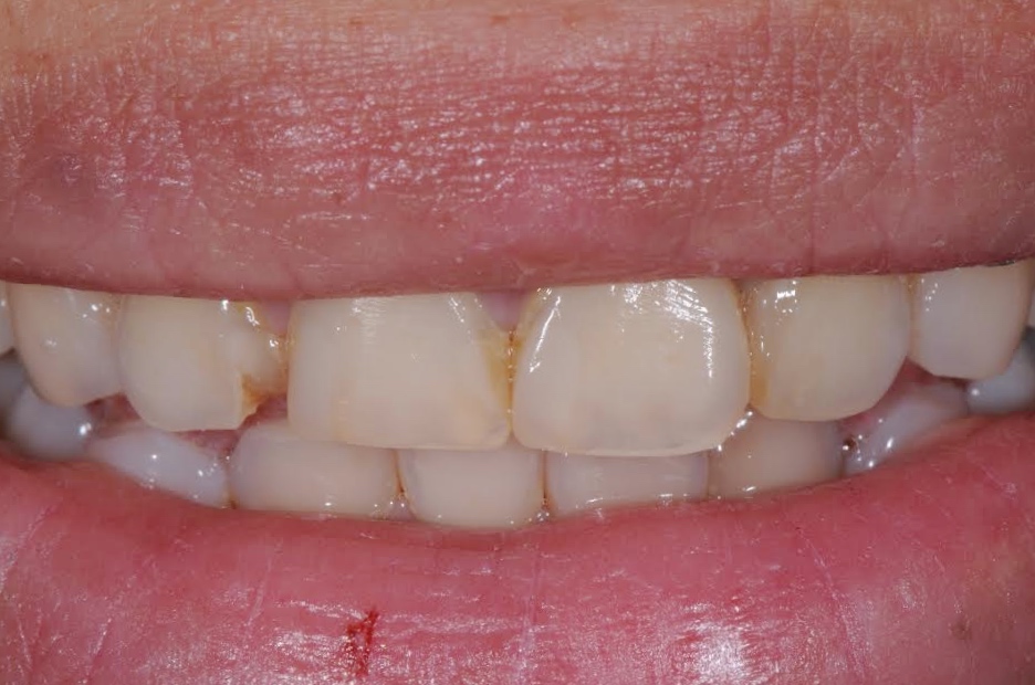 Services Composite Veneers Brisbane Prosthodontics