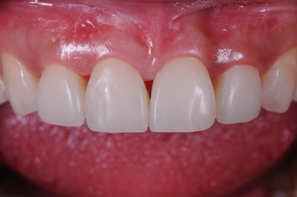 After composite veneers