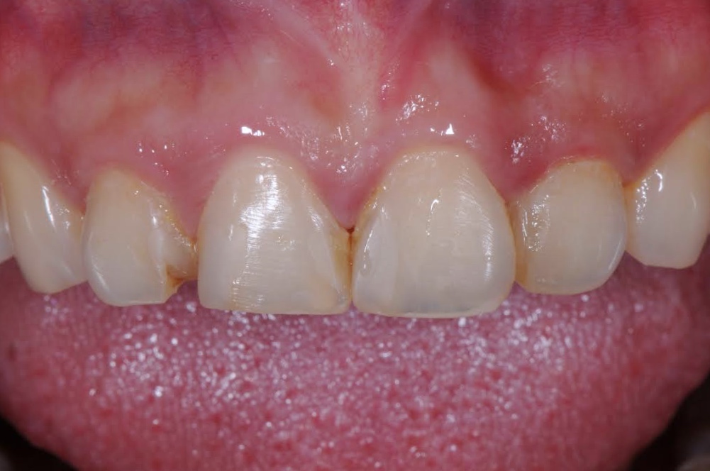 Services Composite Veneers Brisbane Prosthodontics