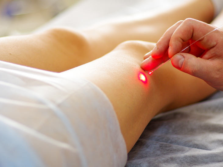 Varicose Veins and how to treat them with RFA