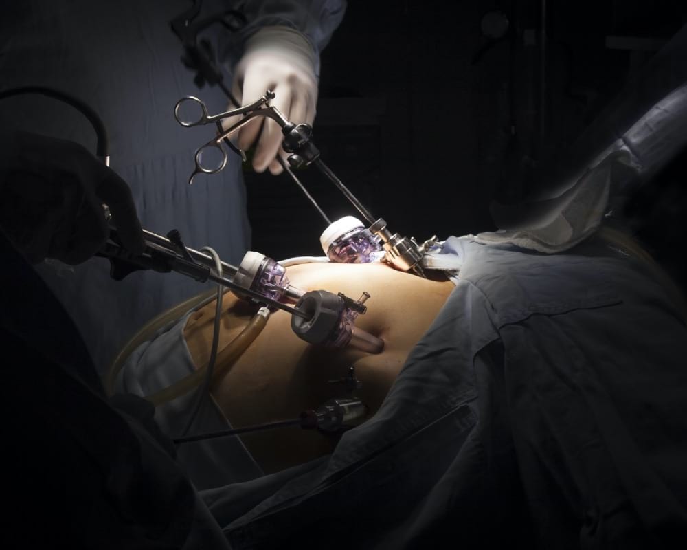 Beyond Weight Loss – 5 Benefits of Getting Gastric Bypass Surgery