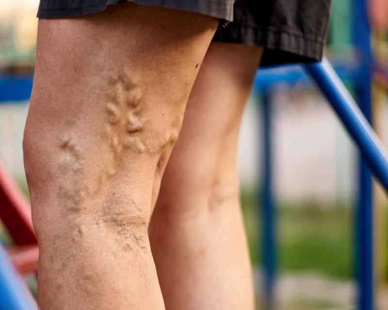 Laser Treatment For Varicose Veins 5 Questions To Ask Your Doctor Vein Center In Walnut Creek