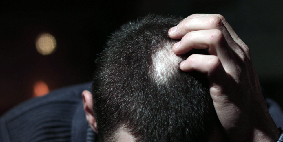 alopecia areata