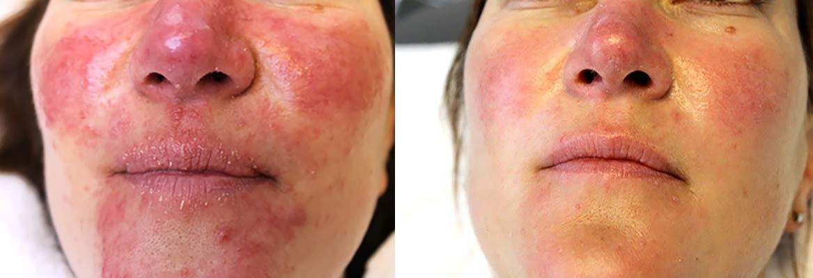 De huid voor en na 2 Rosacea laserbehandelingen bij Laserkliniek Zwolle-Huidtherapie