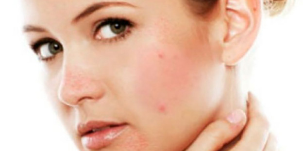 Blozen, blijvende roodheid in het gezicht, bultjes en puistjes dit zijn de vervelende verschijnselen die passen bij het beeld van rosacea.