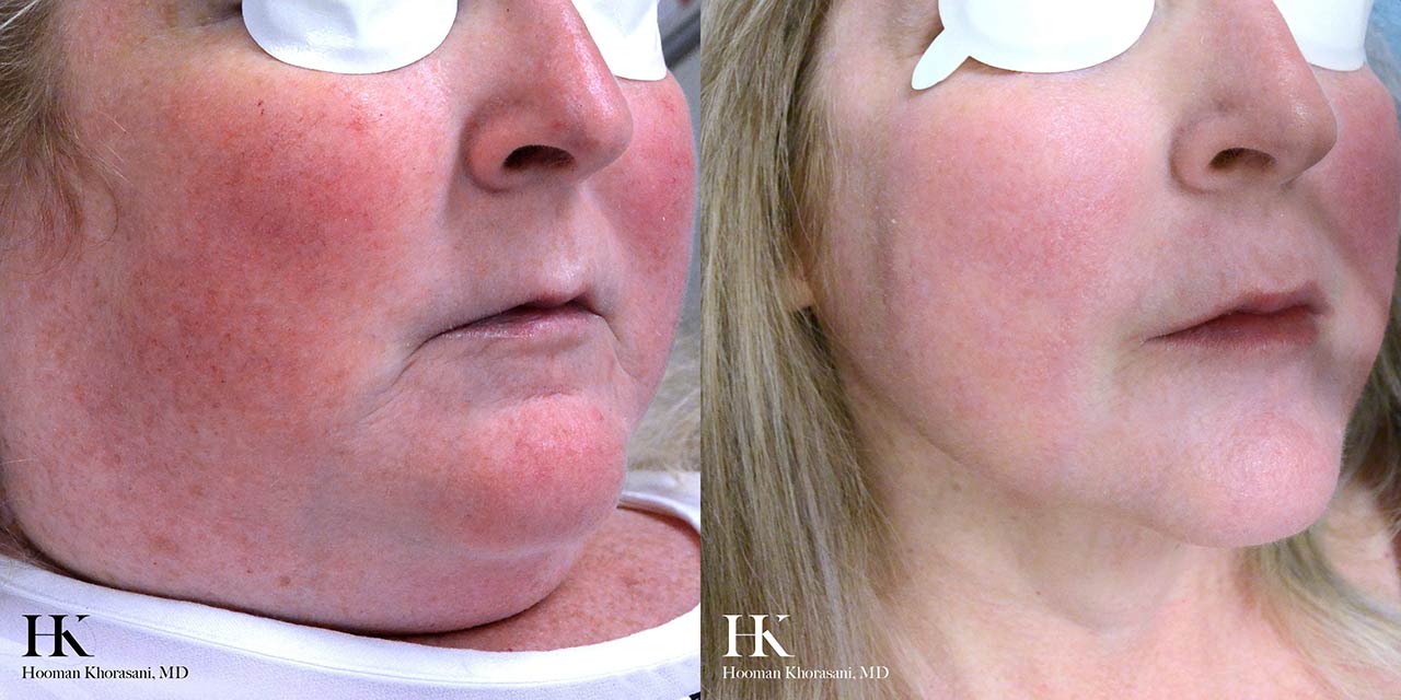 Before & After Photos Vascular Lasers for Redness & Veins Cosmetic