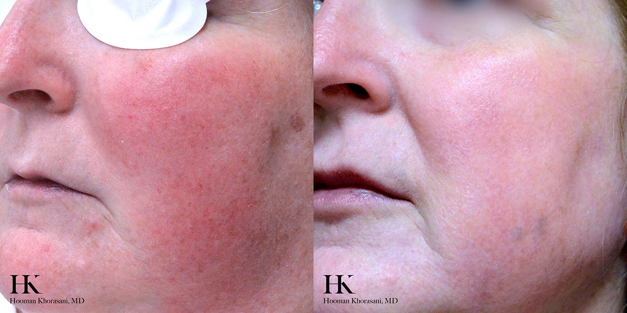 Before & After Photos Vascular Lasers for Redness & Veins Cosmetic
