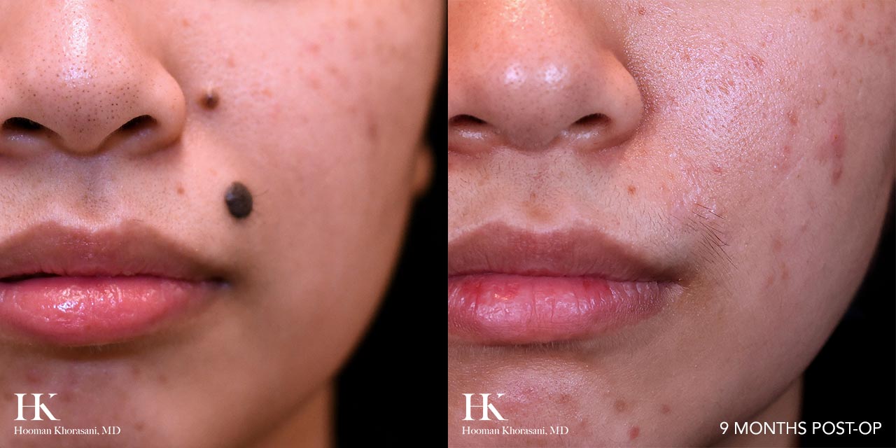 Mole Before And After Removal How To Remove A Mole BVEO