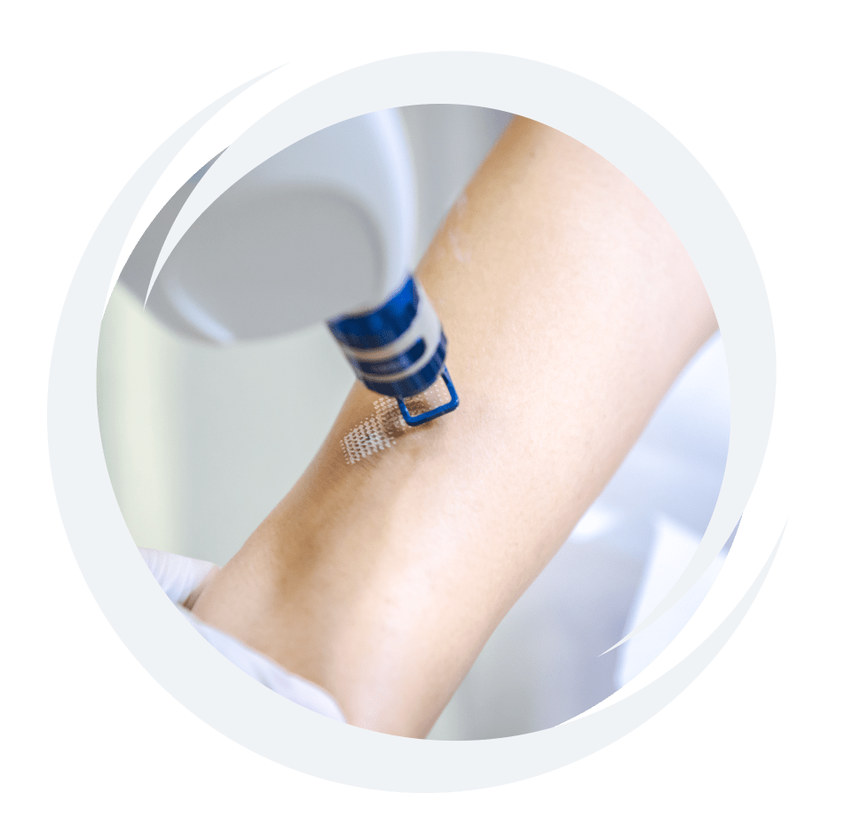 Pixel Laser Resurfacing Este Medical Group