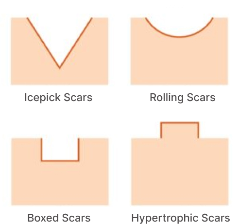 Types of Acne