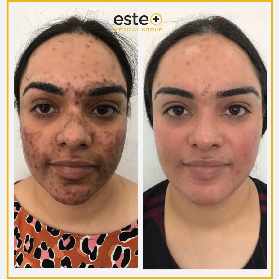 Cosmelan Pigmentation Peel Este Medical Group Cosmelan Pigmentation Peel Este Medical Group