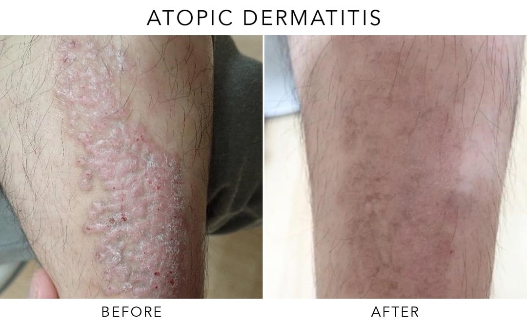 Exciplex Excimer Light Therapy Vitiligo Treatment Este