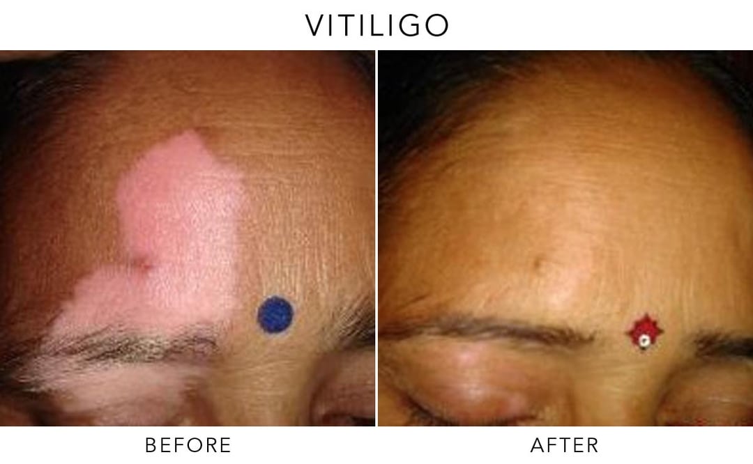 Exciplex Excimer Light Therapy Vitiligo Treatment Este