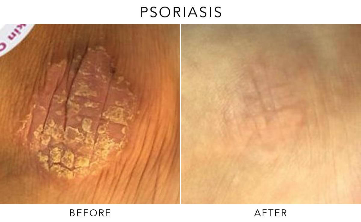 Exciplex Excimer Light Therapy Vitiligo Treatment Este