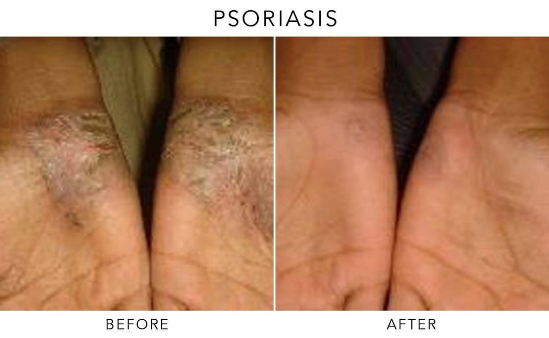 Exciplex Excimer Light Therapy Vitiligo Treatment Este