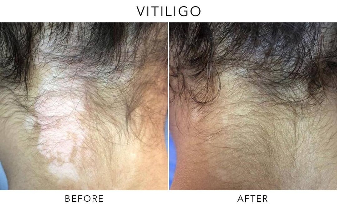 Exciplex Excimer Light Therapy Vitiligo Treatment Este