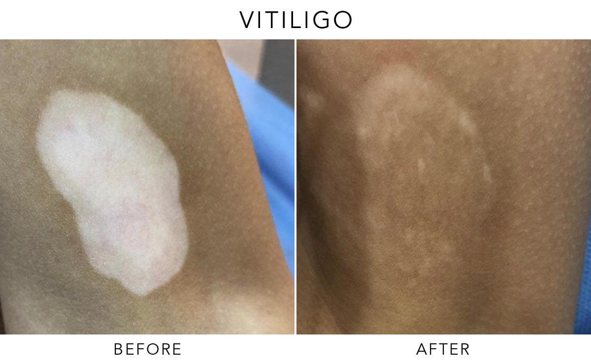 Exciplex Excimer Light Therapy Vitiligo Treatment Este
