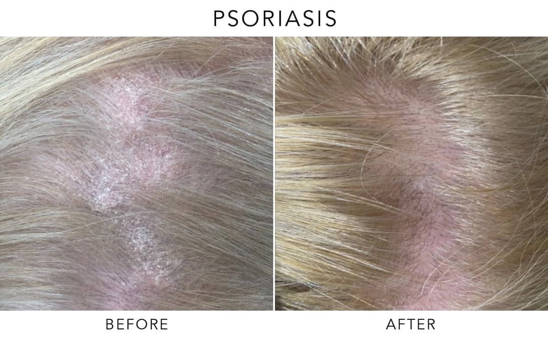 Exciplex Excimer Light Therapy Vitiligo Treatment Este