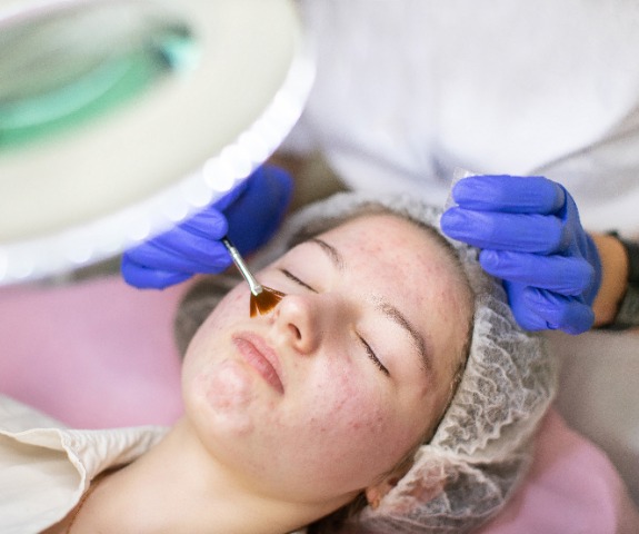 Azelan pigmentation peel
