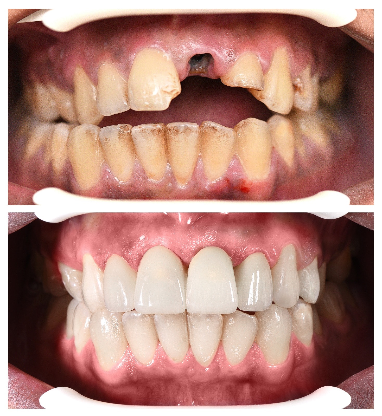Dental Implants Turkey | Dental Implants Before & After