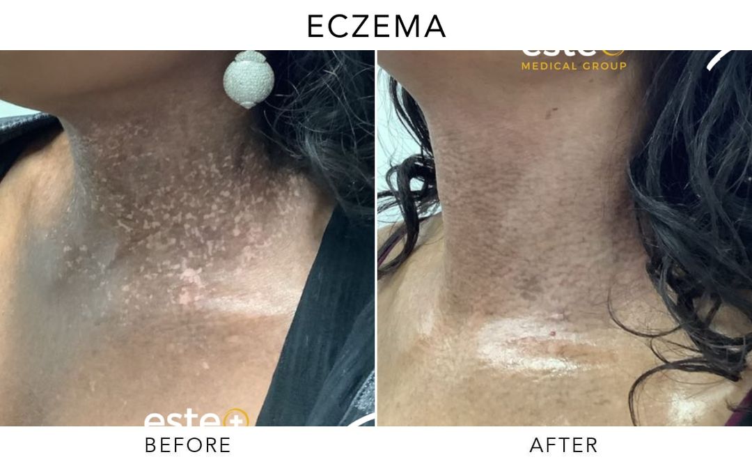 Exciplex Excimer Light Therapy Vitiligo Treatment Este