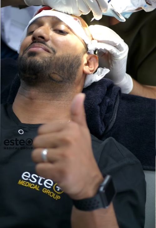 Hair Transplant Before and After Journey’s Este Medical Group