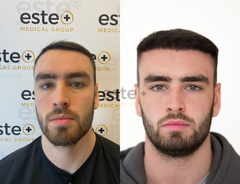 Hair Loss Clinic Glasgow Hair Loss Treatment Glasgow Este