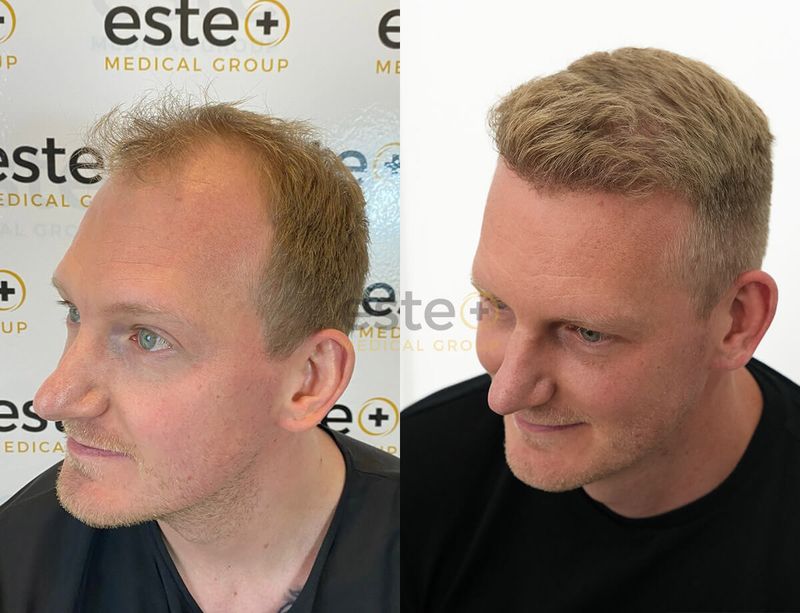 Hair Transplant Before and After Journey’s Este Medical Group